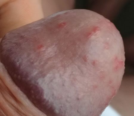 Balanita Candidozica