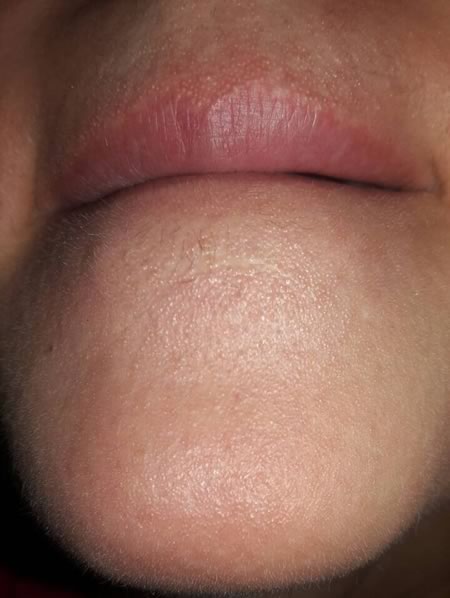 dermatita periorala