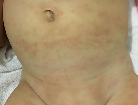 iritatie piele bebelus
