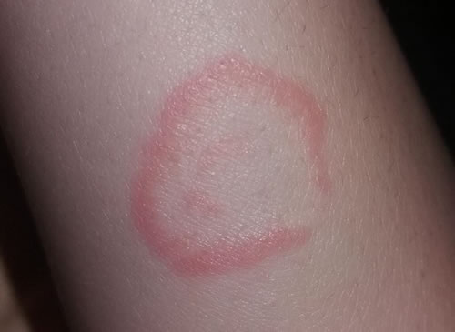 granulom anular