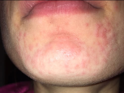dermatita periorala